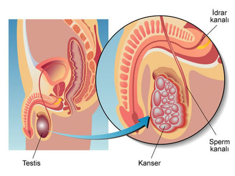 Testis Kanseri