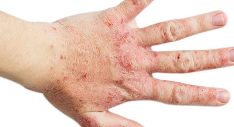 Atopik Dermatit 3
