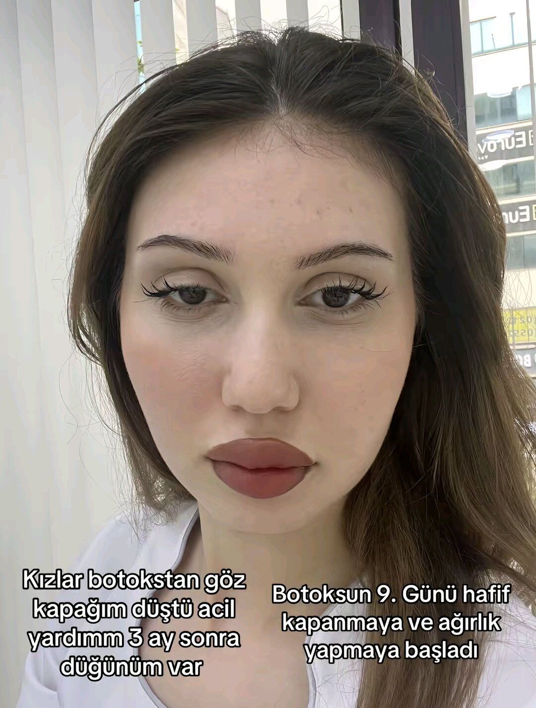 Botoks mağduru genç kadın, kabusa dönen süreci gün gün kaydetti