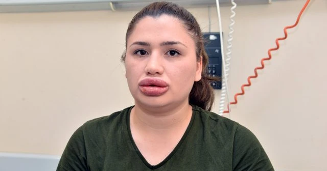Estetik Magduru Hemsirenin Tedavisi Tamamlandi 1495547884