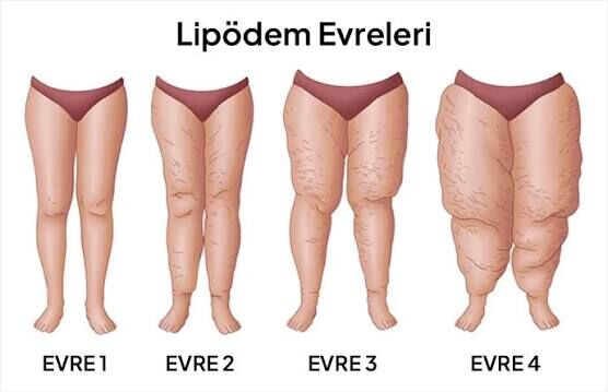 Lipödem Evreleri