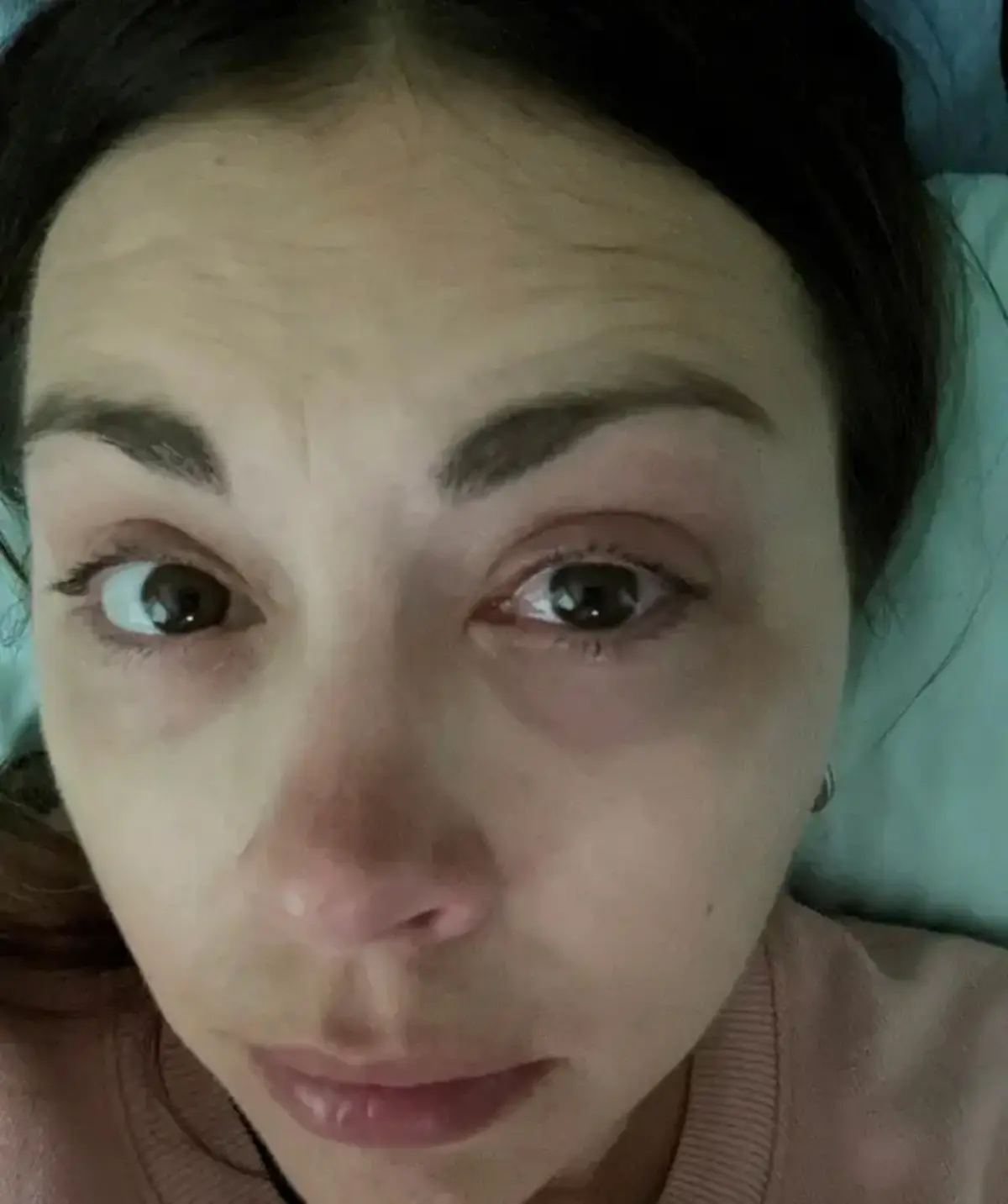 20 Yıl Makyajla Uyudu Göz Kapağı Göz Küresine Yapıştıı