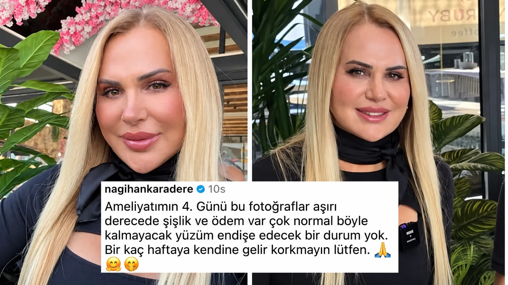 Survivor Nagihan Karadere’den Estetik Sonrası Yeni Paylaşım “Korkmayın Lütfen” (2)